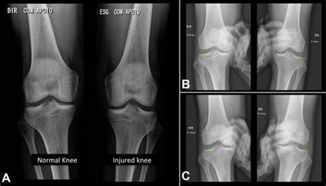 Lateral Collateral Ligament Strain Radiology - Margaret Greene Kapsels