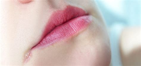 Angular Cheilitis Causes, Treatment and Home remedies