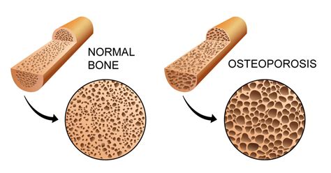 Prevention and Management of Osteoporosis - HealthLinks Gippsland