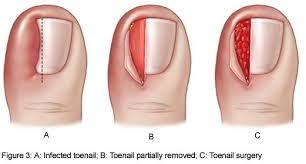 Nail Wedge Resection (Ingrown Toenails) - Queensland Foot Centres