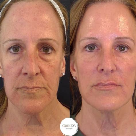 Nonsurgical Facelifts in Denver, CO | Orenda MedSpa