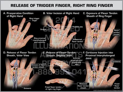 Trigger Finger Anatomy