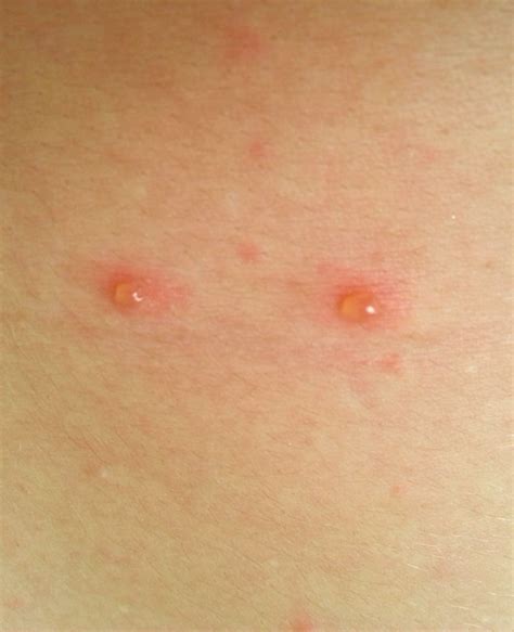 How to deal with chickenpox in adults - The Seaman Mom