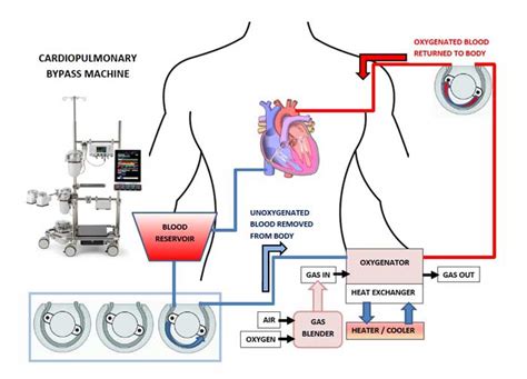 Cardiopulmonary bypass machine - CPB