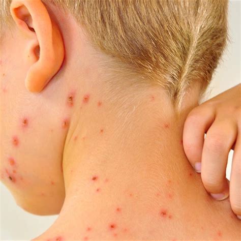Early Stage Measles Smallpox Early Stage Measles Chicken Pox Symptoms - estrelaspessoais