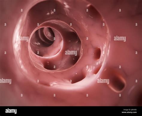 Large intestine diverticulitis hi-res stock photography and images - Alamy