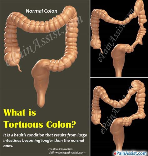 What is Tortuous Colon, Know its Causes, Symptoms, Treatment, Home Remedies, Surgery