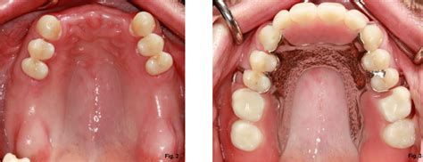 Removable Partial Denture Before And After