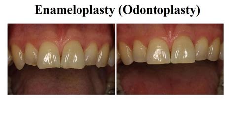 #ODC_fact Enamel shaping also known as odontoplasty is a process in which natural teeth are ...