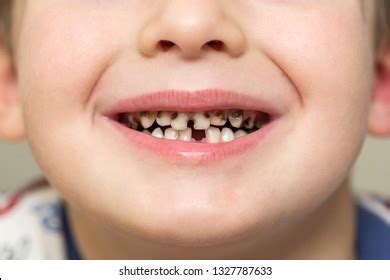 Rotten Teeth Child Royalty-Free Images, Stock Photos & Pictures ...