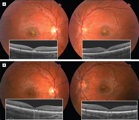 Foveal Injury From a Red Laser Pointer | Ophthalmic Imaging | JAMA ...