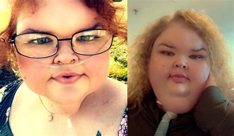 1000 Lb Sisters: Tammy Is Going BALD After Weight Loss Surgery, Facing Side Effects?