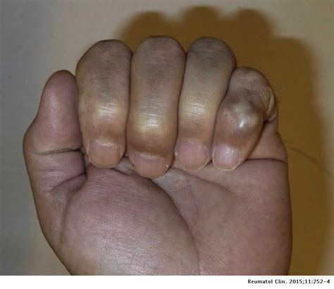 Giant Cell Tumor of the Tendon Sheaths of the Fingers | Reumatología Clínica