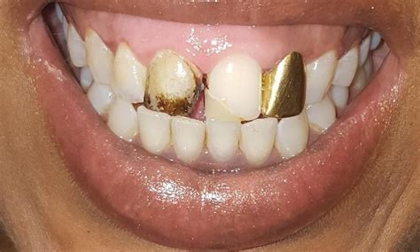 Gold Dental Fillings