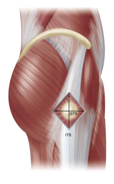 Snapping Hip Syndrome | Musculoskeletal Key