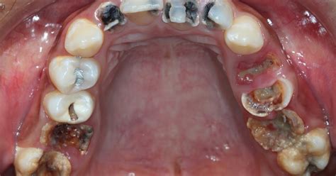 Tooth Demineralization Teeth Treatment