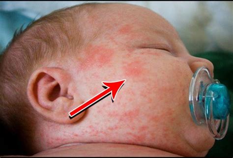 Skin Rash In Babies