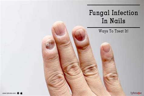 Update 143+ fungal infection nail medicine super hot - songngunhatanh ...