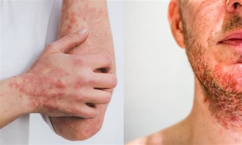 Seborrheic Dermatitis Psoriasis: Differences, Symptoms,, 54% OFF