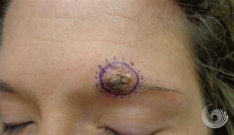 Basal cell skin cancer removal near eyebrow, Mohs surgery before and after