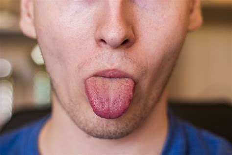 Treatments For Tingling Tongue: Are These Good? - Health Cautions