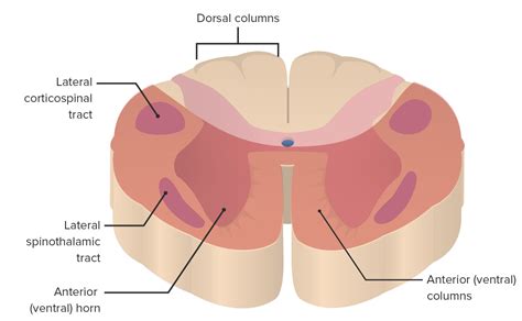 Anterior Spinal Artery Syndrome