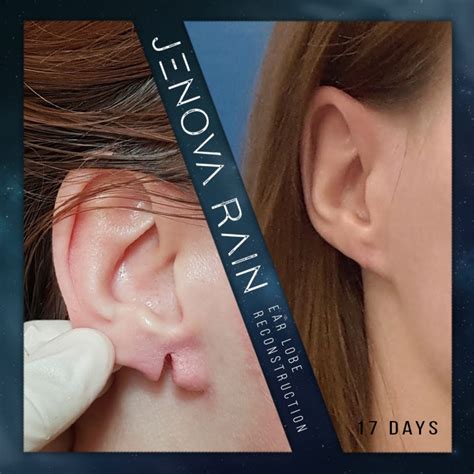 Jenova Rain » Ear Lobe Repair Before and After Photos