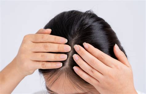 What is Scarring Alopecia? | Scalp Conditions | Dr David Fenton