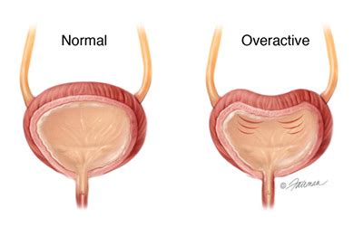 Overactive Bladder (OAB): Patient Guide