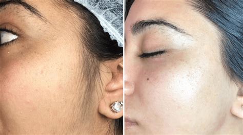 Dermaplaning Treatment - Perfection Cosmetic