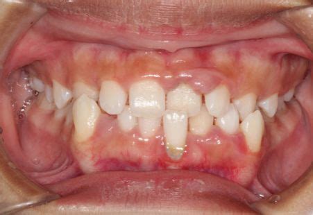 Gingival Hyperplasia: Causes, Signs, 4 Ways To Get Rid Of It