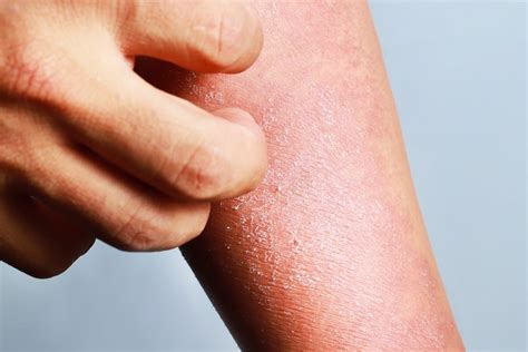 Eczema vs Psoriasis: What's the difference? - Cambridge Therapeutics