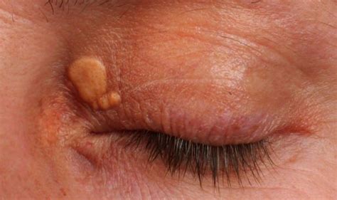 High cholesterol: Symptoms may include xanthomas near the corner of the eyelids | Express.co.uk