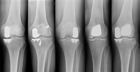 NYC Patellofemoral Partial Knee Replacement | Robotic Partial Knee Replacement