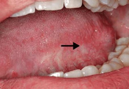 Known cancer patient presenting with a small erosive lesion on the left... | Download Scientific ...