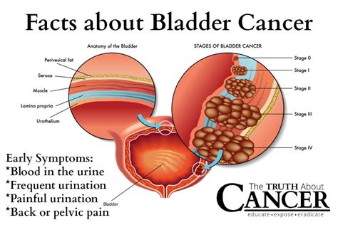 Bladder Cancer – Signs, Symptoms And Causes | Home Remedies