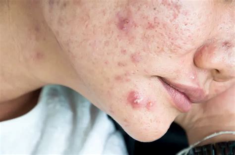 Penting, Inilah Ciri-Ciri dan Cara Mengobati Cystic Acne