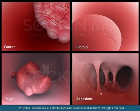 Internal Abdominal Scar Tissue Symptoms