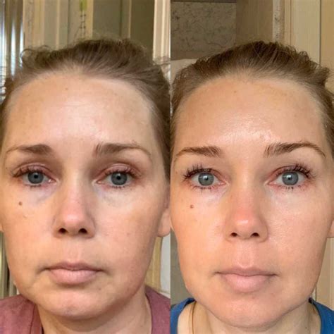 The Process: Tretinoin Before And After - Musely