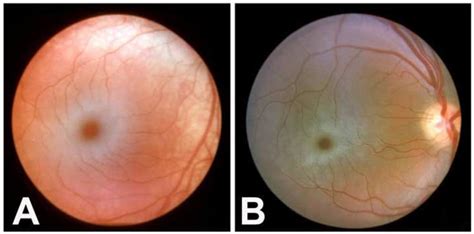 Macular Cherry Red Spots In Niemann Pick Disease Eccles Health | My XXX ...