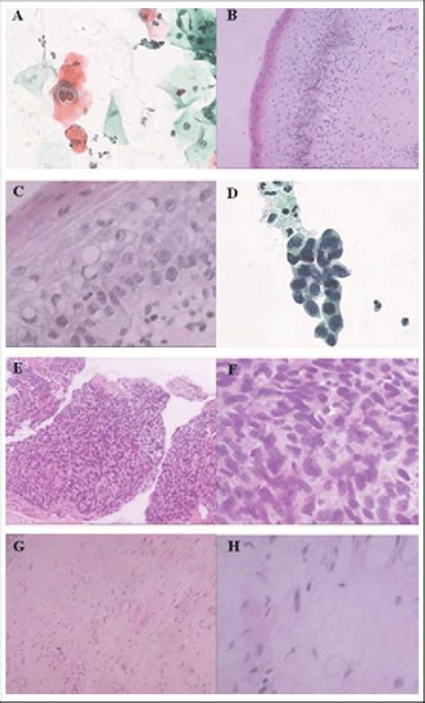 (A) Low-grade squamous intraepithelial lesions (LSILs) of the cervix.... | Download Scientific ...