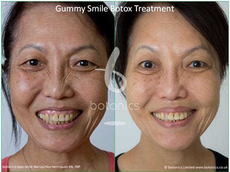 Gummy Smile Treatment with Botox - botonics