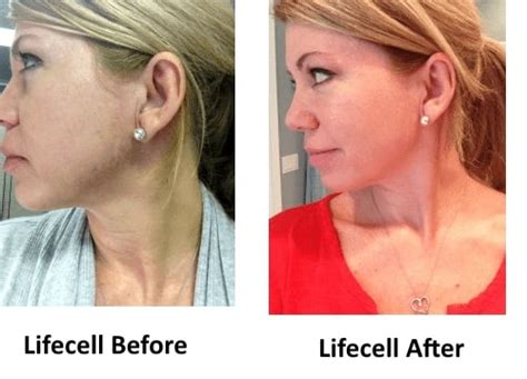 LifeCell Reviews - Does LifeCell Anti Aging Cream Work?