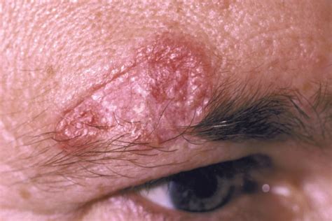 A 37-Year-Old Male with an ‘Itchy’ Lesion on his Face - Journal of ...
