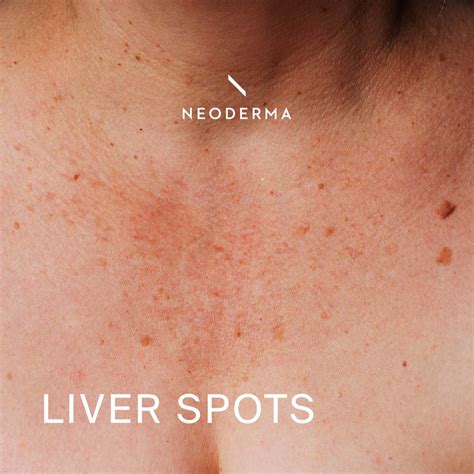 Liver Spot Treatment | NEODERMA