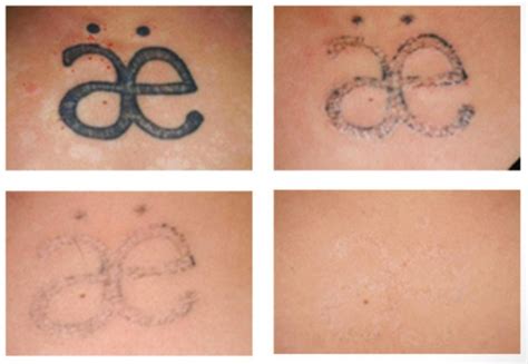 Tattoo Removal Laser – Melbourne Cosmetic Group