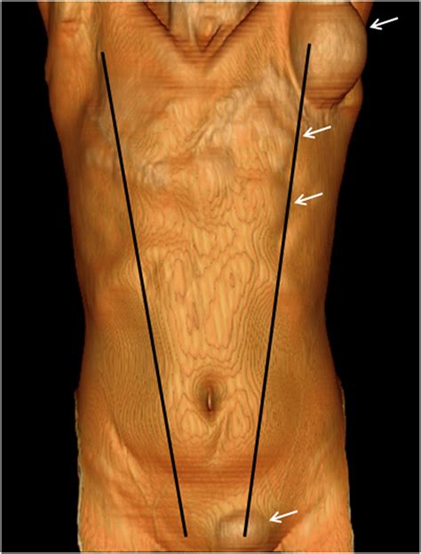 The mammary ridge—A case report of multiple ectopic breast masses - Clinical Imaging