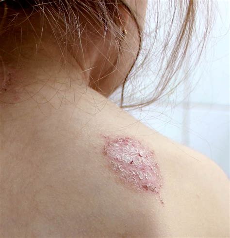 What Are The Different Types of Dermatitis? - Important Facts