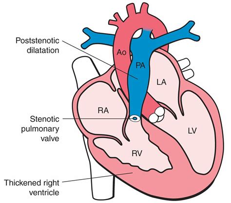 Pulmonary Atresia - Causes, Types, Symptoms, Diagnosis & Treatment