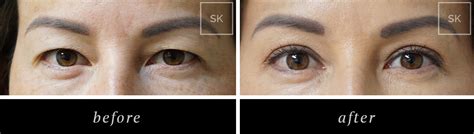 Before and After Eyelid Surgery, Asian Eyelid Surgery Photos - SK ...